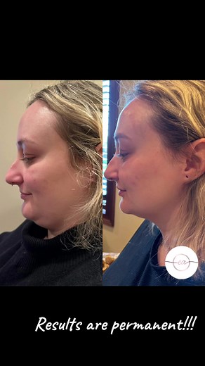 K-Y-B-E-L-L-A Can we all give a round of applause for kybella?! This product is magical and permanently dissolves under chin fat giving you a sharoer jawline. 2-3 sessions are recommended. P.s this is ONLY after 1 sesison. Stay turned for final results. 📍805 Virginia Dr. Orlando, FL 32803 www.evolvingaesthetics.com #juvederm#sculptra#diamondglow#kybella #facials#orlandofacials#medspa#medspaorlando #orlando#florida#lipfiller#lips#lipinjections#dermalfillers#fillers#botox#botoxorlando#orlandoboto