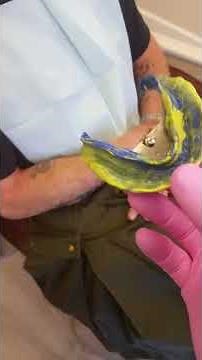 Suction Dentures (SEMCD) - Final Impression Fit Check