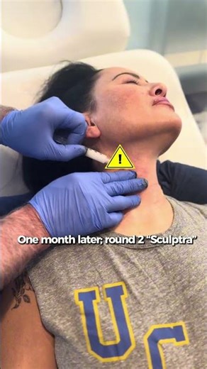 A Patient’s 3-Month Neck Rejuvenation Journey
