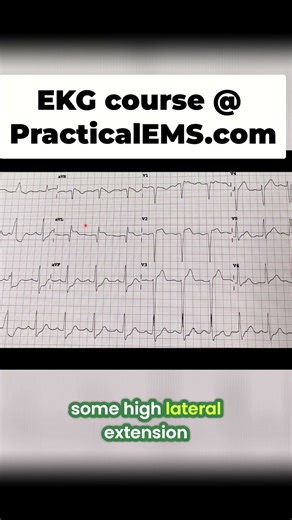 EKG Secrets: Spotting a Heart Attack with ST Elevation! #shorts