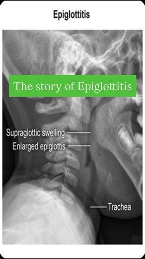 @dareenmohammed2022 on Instagram: "The story of Epiglottitis✨🫰🏻imp points Epiglottitis is a medical emergency characterized by inflammation and swelling of the epiglottis can block airflow to the lungs, making it potentially life-threatening, especially in children. Bacterial infection is the most common cause, especially: • Haemophilus influenzae type b (Hib) – historically the main cause (now less common due to vaccination) • Streptococcus pneumoniae, Streptococcus pyogenes, St