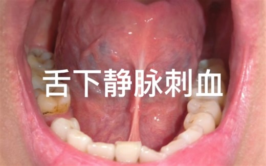 舌下静脉刺血
