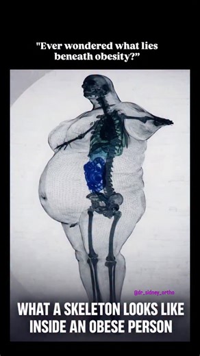 Dr Sidney | Orthopaedic Surgeon on Instagram: "@dr_sidney_ortho - Inside the body of an obese person, the skeleton itself does not dramatically change shape or size. Bones remain largely the same as anyone else’s, but the forces acting on them are very different. Extra body weight translates into constant mechanical load, especially through the knees, hips, ankles, and spine, which are designed to bear movement, not prolonged excess pressure. Because bones do not expand to match added fat mass,