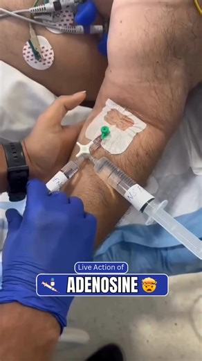 Nursing Wallah on Instagram: "In the world of emergency medicine, a few seconds can change everything — and Adenosine is the perfect example of that. ⚡ This life-saving drug works like a magic reset button for the heart, used in cases of Paroxysmal Supraventricular Tachycardia (PSVT) — when the heart suddenly starts racing way too fast. 💔 Adenosine acts on the A1 receptors in the AV node, temporarily blocking conduction through it. This brief pause allows the heart’s natural pacemaker — the SA 