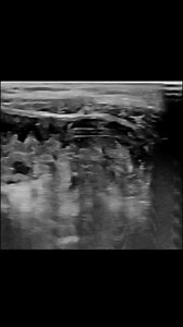 15K views · 73 reactions | Bowel/intestinal ascariasis associated with enteric fever on ultrasound #ultrasound #thehaseebsultrasound #reelschallenge #reelsvideoシ #Radiology #viralreelschallenge #highlightsシ゚ #reelsfacebook | The Haseeb’s Ultrasound Official | Facebook