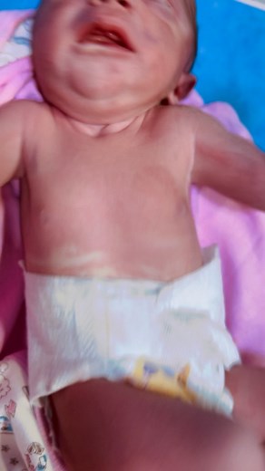 #Babyfirstminutes #love #baby moro reflex, after difficult labor ❤️👶🏻 | Baby first minutes