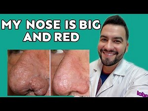 My Nose is Big and Red! Rosacea & Rhinophyma | Dr. David Campos