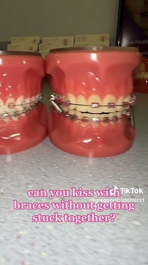 Kissing with Braces: Tips and Tricks