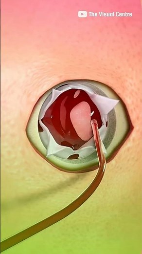 Burr Hole Drainage Surgery