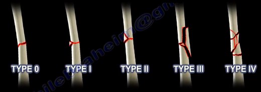 Fractures of the Shaft of the Femur- Winquist & Hansen Classification