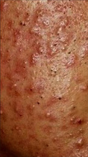 relaxing ASMR SAC Dep Spa BLACKHEADS Removal video #skincare #lashes #relaxer