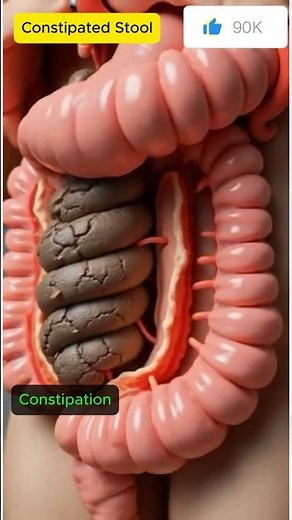 What Constipation Actually Looks Like Inside You 🛑 | Pro10
