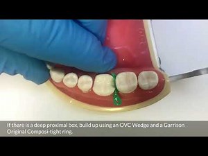 Rhondium Deep Margin Elevation Wedges by Dr. Simon McDonald - Dental Deep Proximal Box Wedge