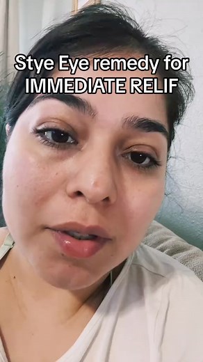 10_How to get rid of a stye eye in less than 30 mins! #styeeye #eyeinfection #fyp #fypシ | Dalila&Jon Ramirez