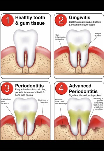 Healthy gums vs gingivitis vs periodontitis 👇 If your gums bleed, your body is warning you. Don’t wait until it becomes bone loss. Prevention is ALWAYS easier than treatment! 🦷✨ #gumhealth #Gingivitis #Periodontitis #DentalHygiene #gumdisease