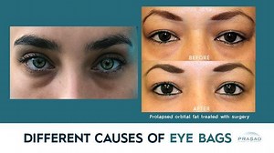 Different Causes of Eye Bags Part 2