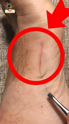 نمو شعر تحت الجلد! #الشعر_تحت_الجلد #جلدية #عناية_بالبشرة #الحلاقة #التهاب_الجلد #اكريتين #SkinCare