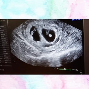 Colleen Ballinger on Instagram: "IM HAVING TWINS! watch the full video on my youtube channel now! (link in my bio) 👶🏼👶🏼"