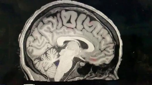 "“Scientists capture the full ‘brain-cleaning’ process during sleep”Sleep is crucial for the brain. When a person is in deep sleep, cerebrospinal fluid flows between neurons like waves, clearing metabolic waste and “resetting the system” for thinking and learning the next day. But what happens if you don’t get enough sleep?Scientists at Boston University in the United States have captured this “cleaning” process. Red represents blood, and blue represents cerebrospinal fluid. After falling asleep