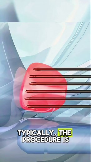 2.4K views · 17 reactions | Prostate Biopsy #ProstateHealth #ProstateBiopsy #ProstateCancer #ProstateScreening #PSATest #MenHealthMatters #ProstateAwareness #ProstateCheck #BPH #EnlargedProstate #ProstateTreatment #BiopsyProcedure #Urology #MensHealth #CancerScreening #EarlyDetection #ProstateGland #ProstateDisease #ProstateExam #HealthForMen | Surgery Page | Facebook