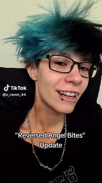 Best piercing ever!! *pls inform yourself abt bioflex before getting it, according to a comment it could be bad for you. I didn't know abt this and my piercer gave it to me but as always it's a personal choice and at your own risk #reversedangelbites #angelbites #angefangs #newpiercing #piercing #alt #alttiktok #fyp #viral #fypシ゚viral