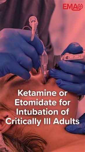 Planning to intubate a critically ill patient? 🫁💉 What are you reaching for in RSI—ketamine or etomidate? The RSI Trial takes a hard look at this long-debated question 🔹 No mortality difference between ketamine and etomidate 🔹 Challenges concerns about etomidate-induced adrenal suppression 🔹 But here’s the twist: ketamine was linked to higher rates of cardiovascular collapse during intubation—especially in septic and high-severity patients ⚠️ Practice-changing data? Let’s take a listen to t