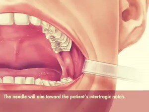 11K views · 407 reactions | Gow-Gates Nerve Block Technique | Dr.Sreenath S | Facebook