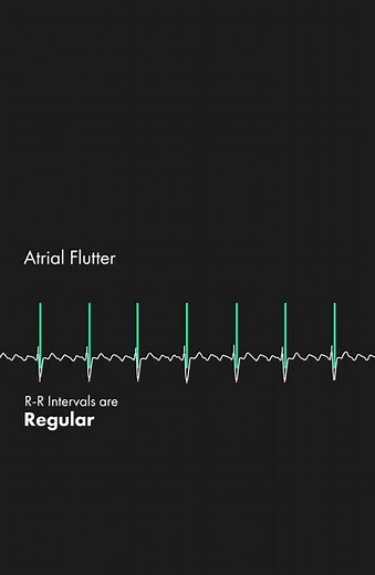 Atrial fibrillation vs Atrial flutter🫀