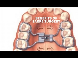 BENEFITS OF A SARPE SURGERY