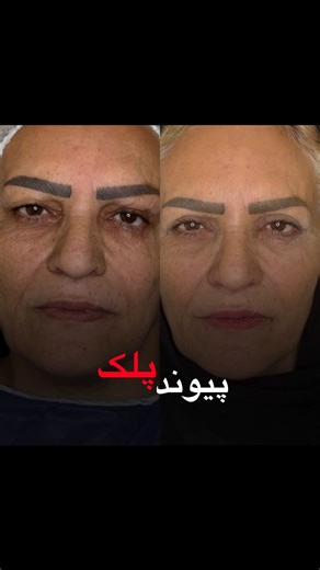 ‎دكتر دستگيرى|ليپوغبغب|بوكال|بلفارو|ليفت |پيكرتراشى‎ on Instagram‎: "این هم پیوند پلک برای مراجعه عزیزمون که چند سال پیش در تصادف براشون جراحت سنگین ایجاد شده بود @dr.dastgiri @belfa_lift _______________________________________________ #بلفارو #پیوند_زدن #دکتردستگیری #بلفاروپلاستی #پیوندپلک#بلفاروپلاستی_پلک"‎