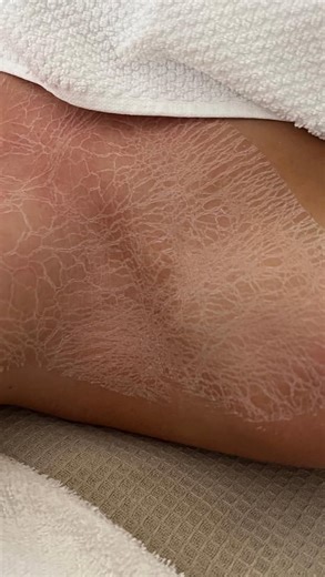 KATIE LAWRENCE + CO on Instagram: "✨SKIN NEEDLING - THE HOLY GRAIL OF SKIN TRANSFORMATION ✨ ⬇️ When paired with the Dermapen, skin needling becomes a whole new level of results. This isn’t your at-home roller or your cosmetic skin needling treatments.. this is professional precision, depth control and medical grade power designed to actually remodel your skin - not just tickle the surface. Think: ✨ Scar revision that finally makes a difference (scars not just on the face!) ✨ Smoother, firmer, ti
