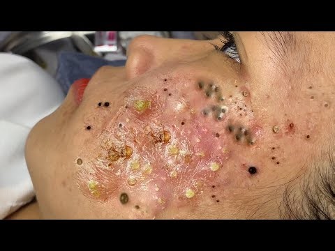 حلول طبيعية لبشرة صافية#𝐋𝐍𝐆TT