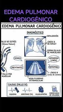 Cardiogenic Pulmonary Edema: Pathophysiology, Diagnosis and Treatment 🫁