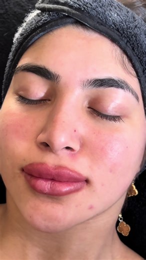 Transform Your Skin with Diamond Peel Facial