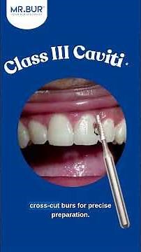 G.V. Black’s Caries Classification Explained (With Dental Burs for Each Class!)