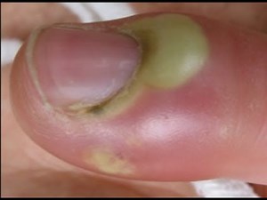 Ponction d'un panaris collecté COVID 2020