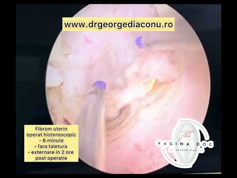 Miomectomie pe cale histeroscopica - Fibrom 2 cm‼️