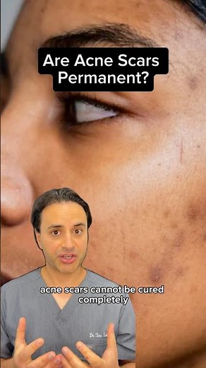 Are Acne Scars Permanent? Dr Solomon explains how to treat them | Dr. Medispa