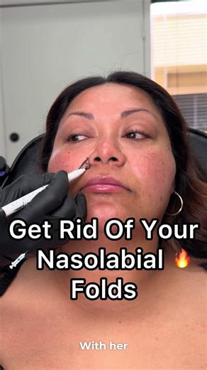 Subtle Enhancement, Strategic Placement ✨ Injecting dermal filler into the piriformis, just lateral to the nose, can effectively support the midface and soften nasolabial folds without directly overfilling them. This technique enhances facial structure by restoring deep volume loss, lifting the cheek naturally, and maintaining a balanced, refreshed look. 💉 Less is more when placed precisely. #FacialAnatomy #MidfaceRejuvenation #PiriformFossa #NasolabialFolds #FillerTechnique NaturalResults