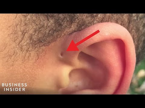 Explaining A Preauricular Sinus, A Tiny Hole Above Some People's Ears