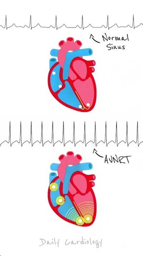 Heart's Conduction in NSR vs AVNRT #shorts #ecg #svt #cardiology #hearthealth