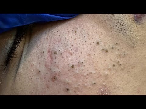 Ultimate Blackhead and Pimple Removal — Clear Skin Routine