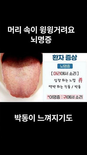 뇌명증 오른쪽 머리에서 소리가 나는 경우 vs 왼쪽 머리에서 소리가 나는 경우