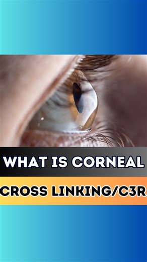 What is Corneal Cross Linking / C3R Contact us on 9711116605 http://eyemantra.in// A1/10, paschim vihar West Delhi -63 | B-62, Prashant vihar, Rohini sector -14 . . #keratoconustreatment #cornealcrosslinking #c3r #crosslinking | EYE Mantra