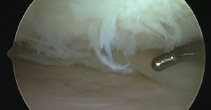 Should you wear a knee brace after meniscus surgery? | Dr Geier