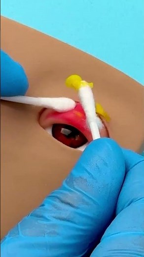What’s Inside an Infected Eyelid?