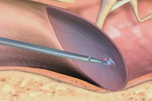 Myringotomy, the incision of the eardrum membrane