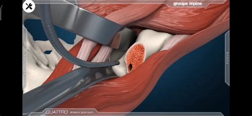髋关节置换手术过程，3D演示。。