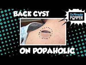 Back Cyst on a Popaholic... baby!
