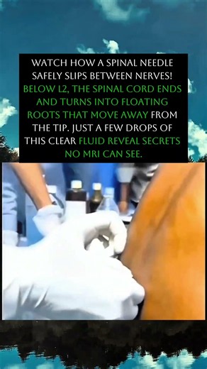 Watch How Doctors Take Spinal Fluid